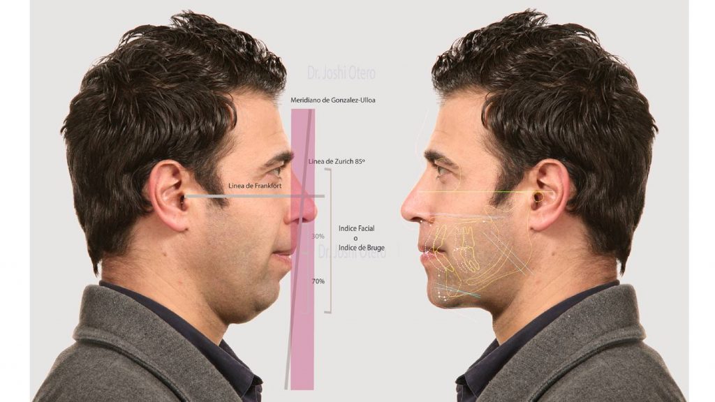 Análisis facial inicial de un hombre de perfil con simulación posterior de la posición ideal del tercio inferior