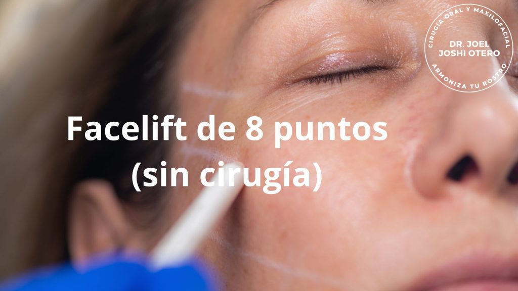 Lifting facial: planificación de los puntos clave de tracción del SMAS