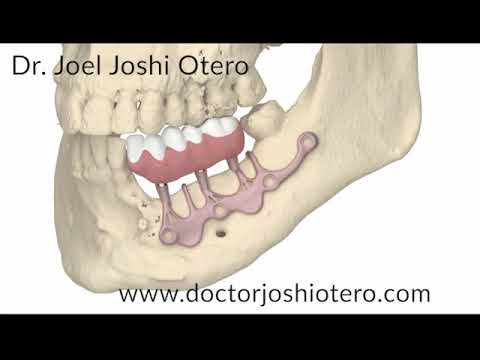 Implante monocortical subperióstico AMSJI para maxilar atrófico severo sin injertos óseos