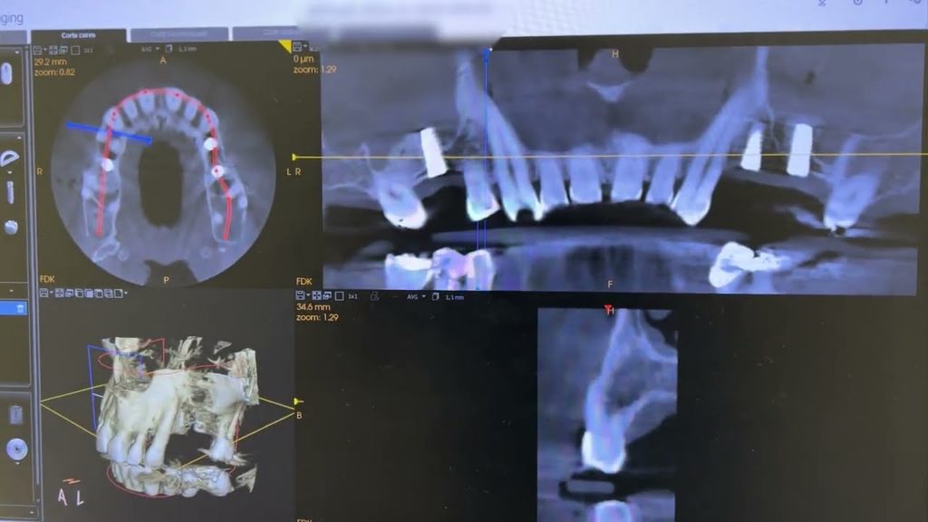 Elevación de seno maxilar (sinus lift) para colocación de implantes en maxilar atrófico
