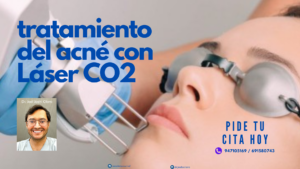 tratamiento del acné con láser Co2