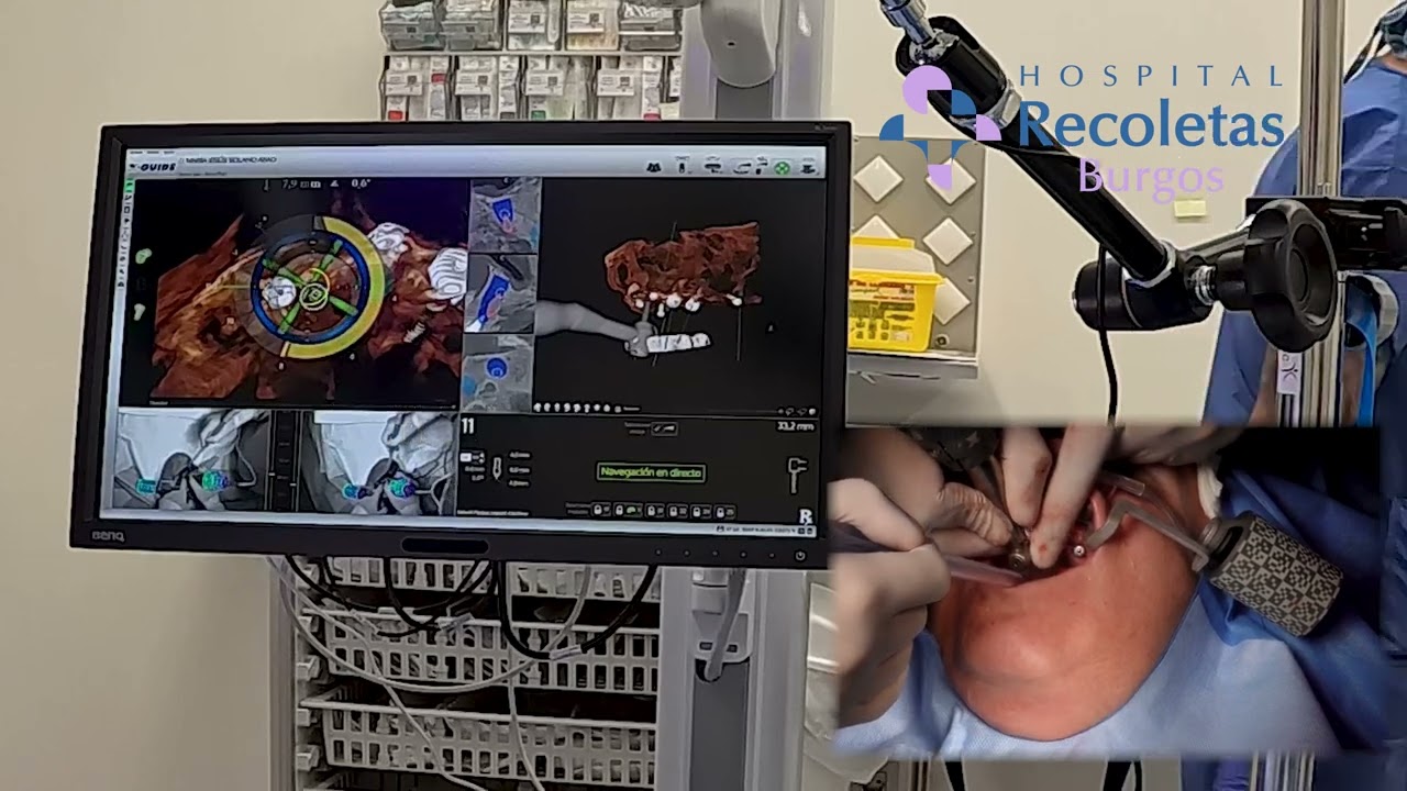 Implantes dentales con navegación dinámica X-Guide Nobel Biocare - Hospital Recoletas Burgos