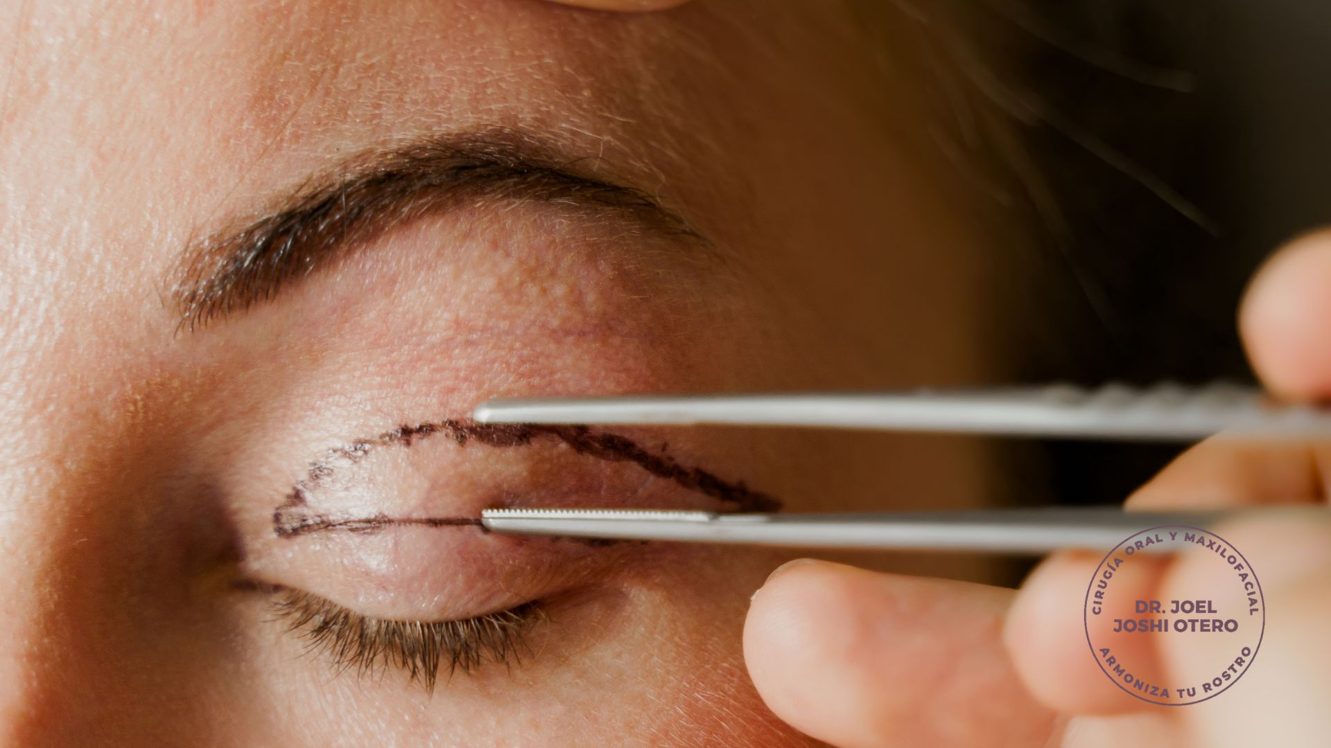 Diseño de blefaroplastia Dr. Joel Joshi