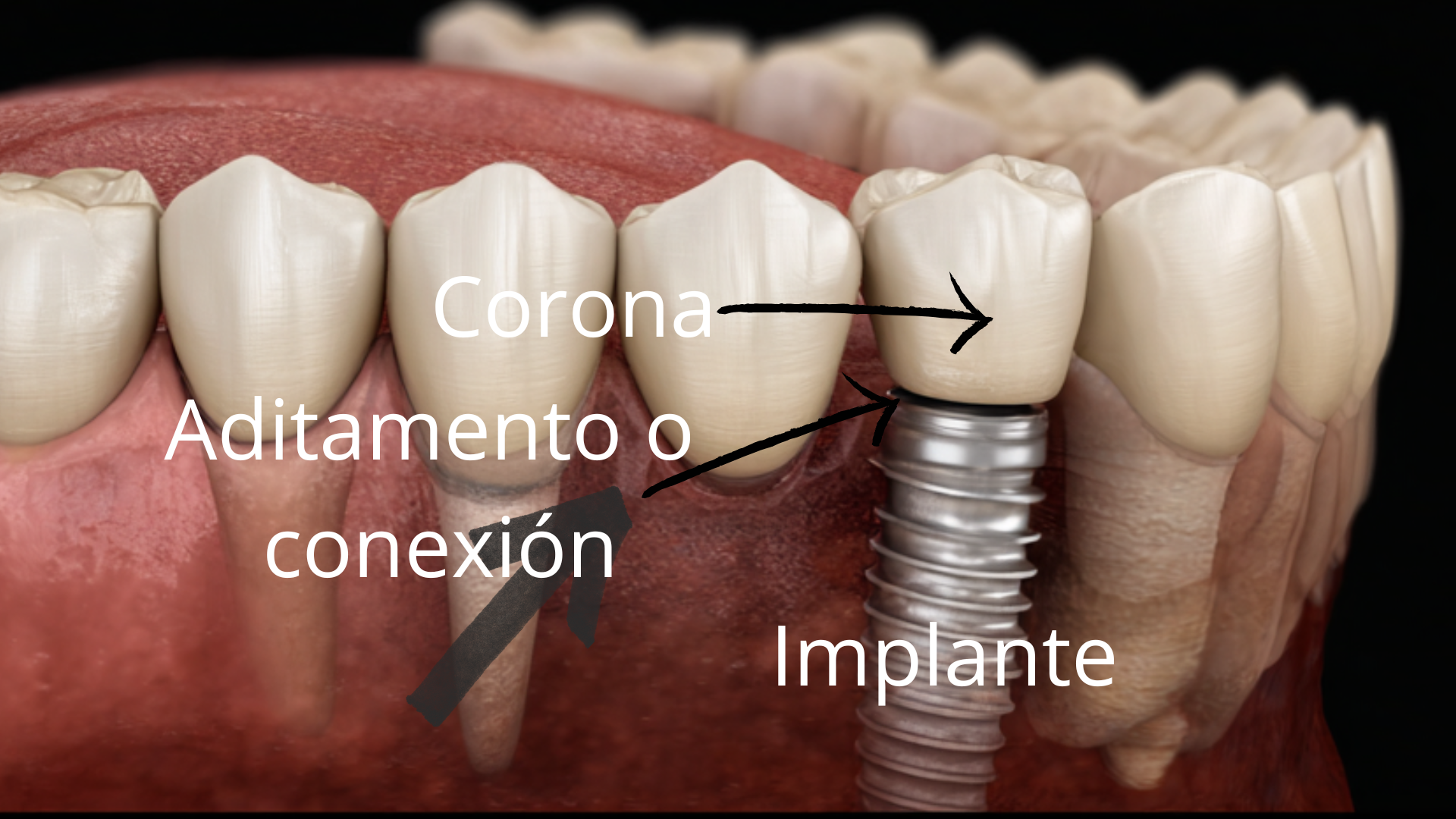 Implante dental con navegación dinámica en Burgos - Dr. Joshi Otero