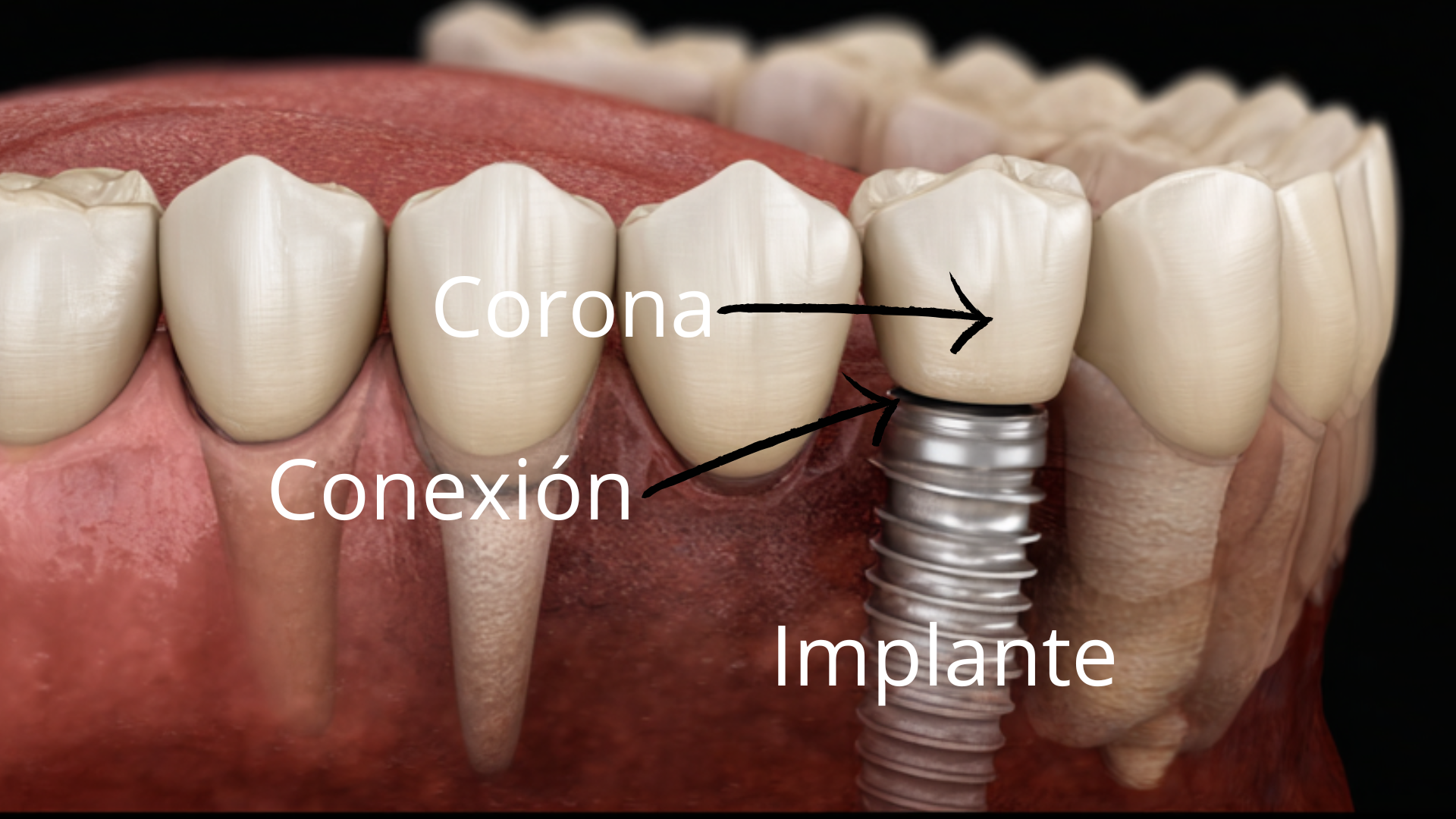 Implantes dentales con navegación dinámica - Dr. Joel Joshi Otero Burgos