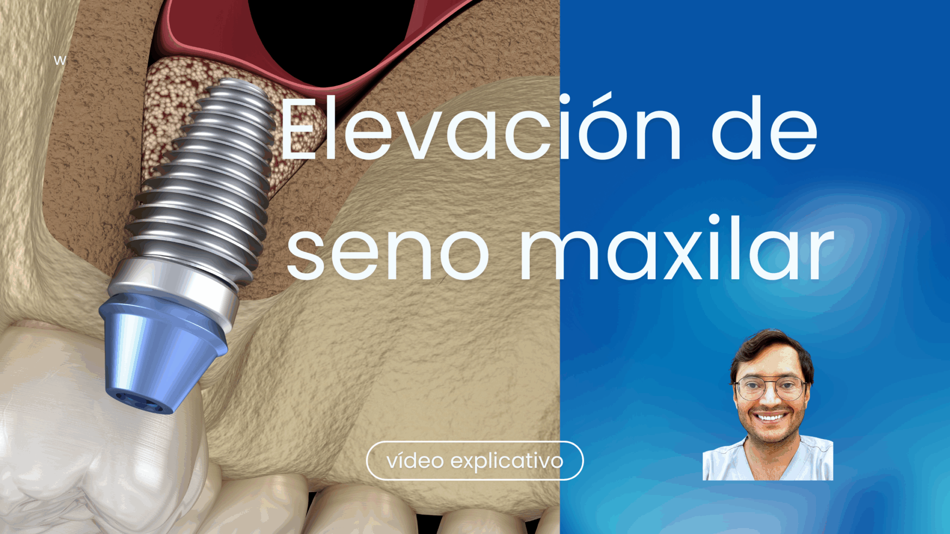 Elevación de seno maxilar con navegación dinámica - Dr. Joshi Otero Burgos