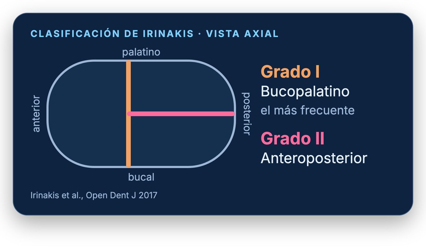 Esquema de la clasificación de Irinakis de los septos del seno maxilar en vista axial: grado I bucopalatino y grado II anteroposterior