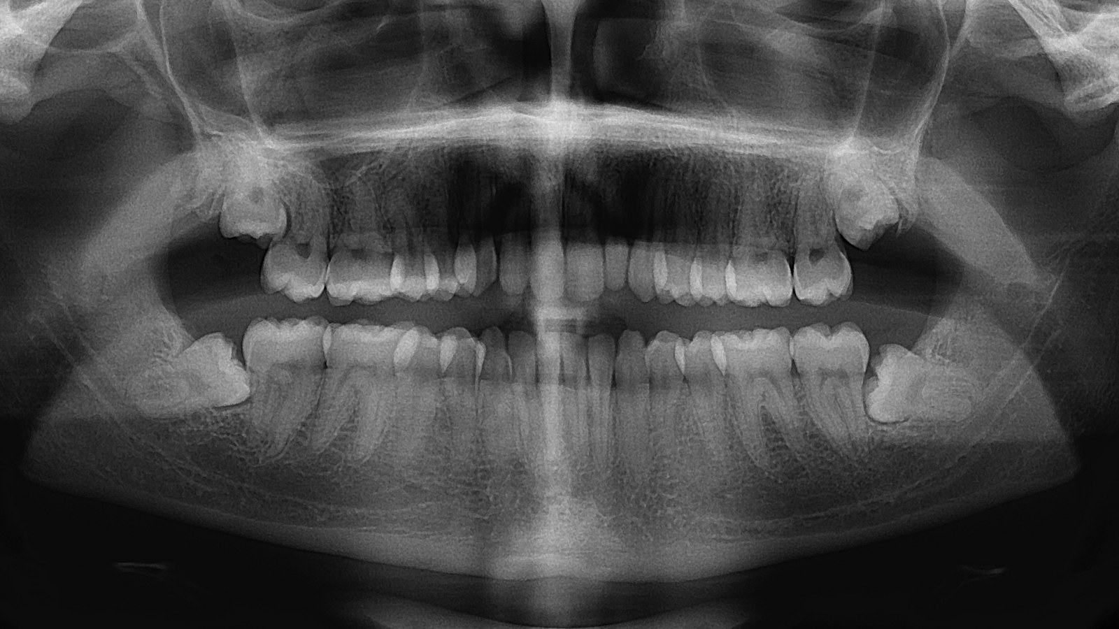 Radiografía panorámica con las cuatro muelas del juicio incluidas