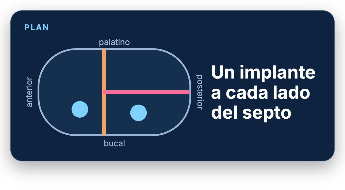 Esquema del plan quirúrgico: un implante a cada lado del septo del seno maxilar
