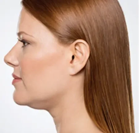 Antes-eliminar-papada